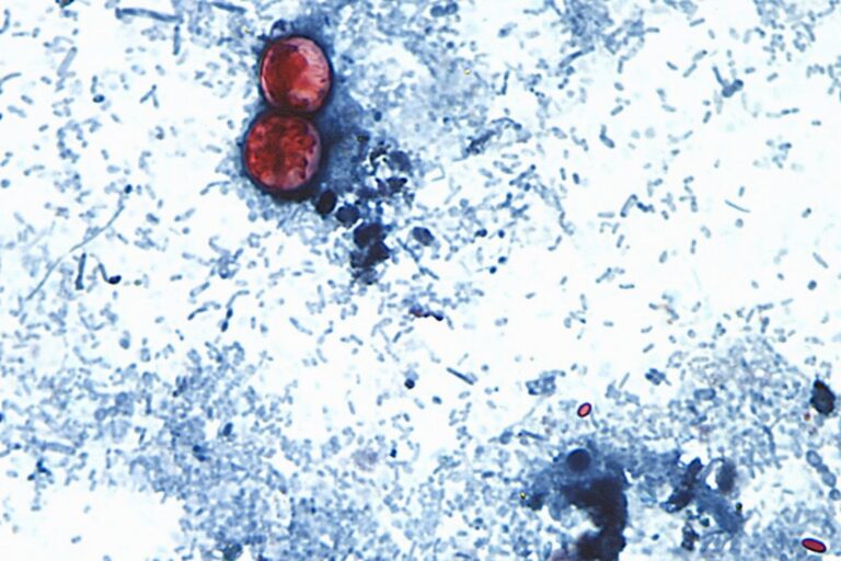 Ciclosporiasis: Primeras muertes registradas en EE.UU. en medio de un brote alarmante